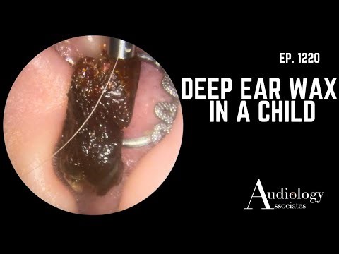Paediatric Ear Wax Removal | Deep Plug Safely Removed by Audiologist - EP1220