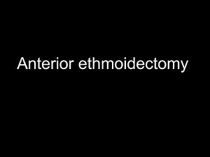 anterior ethmoidectomy