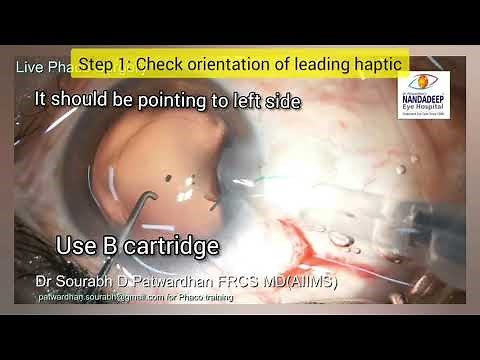 How to insert 3 piece IOL in the bag Dr Sourabh Patwardhan