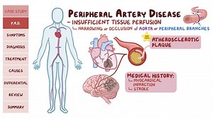 Video: Peripheral artery disease: Pathology review - Video Explanation! | Osmosis | Osmosis