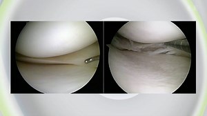 Meniskus - Zu häufig operiert