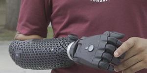 ‘It was like Christmas Day’: Fort White teen injured in ATV crash shows new bionic arm