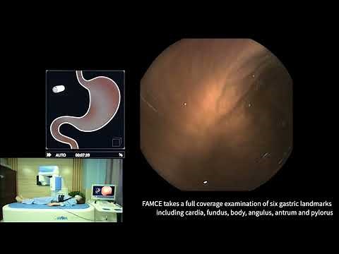OMOM Robotic Capsule Endoscopy System Procedure