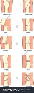 Types Bone Fractures Infographic Vector Stock Vector (Royalty Free) 2097363271 | Shutterstock