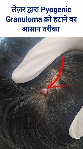 Pyogenic Granuloma | Treatment of Red Lesions on the Scalp | RF Ablation of Red Lesions of the Scalp