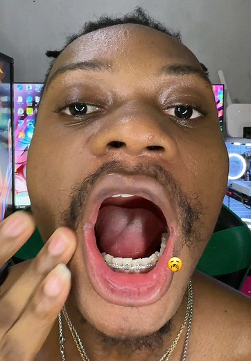 Braces Journey: Power Chain Update and Retainer Options