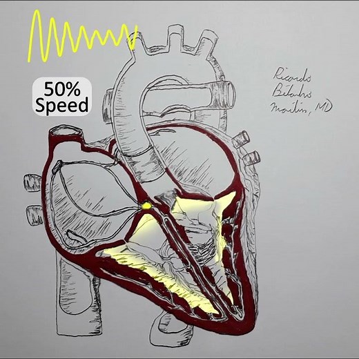 Polymorphic Ventricular Tachycardia explained in 50 seconds