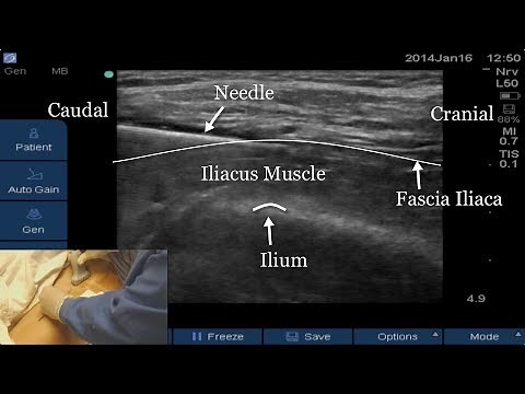 US-Guided Fascia Iliaca Block: FULL VIDEO LINK BELOW