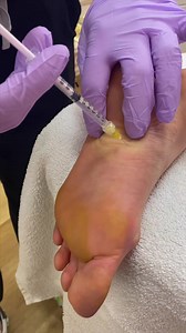 Botox works from head to toe! Did you know botox in the calf muscles (or plantar fascia) has multiple advantages? From pain management, to slimming, to reduction of muscle spasms. Suffering from plantar fascists? Botox will help woth that too! Dr. Kaado is an expert at injecting just the right amount in just the right places to offer much needed relief in this difficult area. • • •• • To schedule an appointment or speak with a member of the Kaado Krew, please contact us : ☎️ 757-788-4508 📧 appo