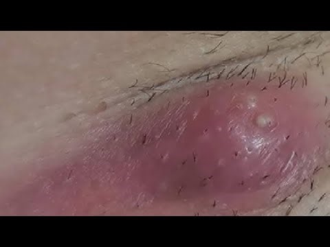 REMOVE A BOIL STEP BY STEP DO THIS RIGHT NOW