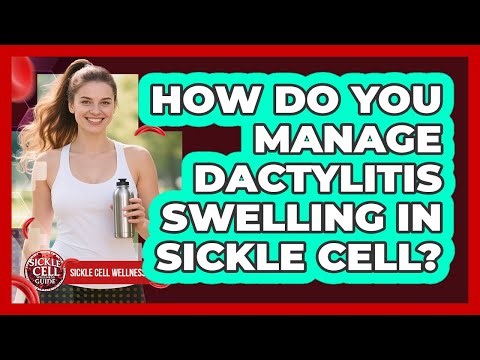 How Do You Manage Dactylitis Swelling in Sickle Cell?
