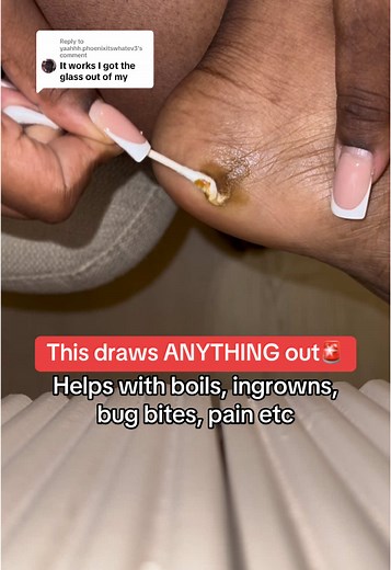 Replying to @yaahhh.phoenixitswhatev3 I love this stuff, it really helps to draw out any irritant that’s in your skin to the surface!