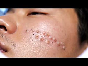 Blackhead Extraction That Reveals Hidden Pores | Close-Up View