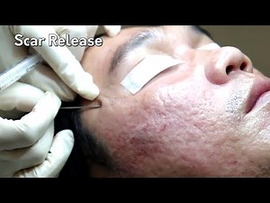 SCAR RELEASE: Leave the deep scars behind