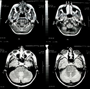 Male and Female Brains: Similarities and Differences