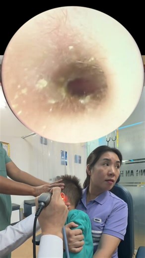 Earwax removal for children | Gentle and safe procedure,#healthstories #humanbody #medicalcases