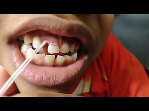 How to pull your teeth out with a piece of string