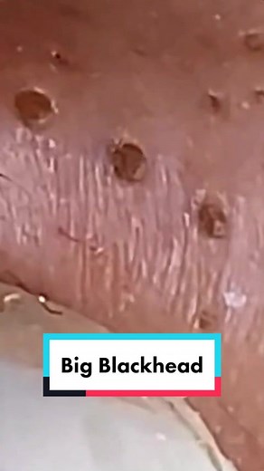 Pimple Satisfying on TikTok