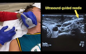 Hydrodissection of the cervical plexus and auricular temporal nerve
