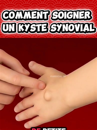#operation #medecine #chirurgie #apprendre ​Le kyste synovial, c’est cette petite boule un peu dure qui apparaît soudainement sur votre poignet ou au pied. Ce n’est pas une tumeur, c’est juste une sorte de petite bulle de « gelée » qui s’est échappée de votre articulation. Imaginez que votre jointure est comme une chambre à air : avec l'usure ou un faux mouvement, une petite hernie se forme et se remplit de liquide lubrifiant. Parfois ça ne fait rien, mais parfois ça appuie sur un nerf et là, ça