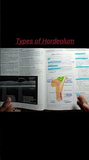 Types of Hordeolum | Stye | #medicalmedics #clinicalophthalmology
