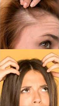 Watch out! That dry scalp might not just be dandruff