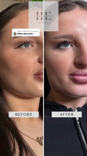 Lemon Bottle: Fat Dissolving Benefits Explained