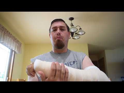 ECU Subluxation surgery revision