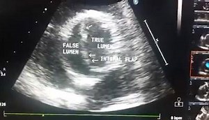 Case: 48 Type A Aortic Dissection. Dissection involved in Aortic Arch & its Branches. Echo Report Type A Aortic Dissection Dissection involved in Aortic Arch & its branches, Thickened & Calcified AV, Moderate to Severe AR, Dilated Aortic Root, Concentric LVH, Dilated LV, Mild MR, Mild TR, No RWMA, Normal LVSF , No PE, EF: 60%. | Interesting cases in Echocardiography