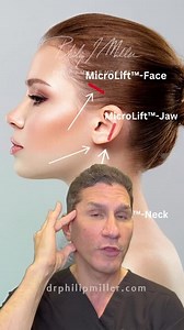 MicroLift- Face Jaw Neck! Facelift under local anesthesia to give you a refresh look the weekend!