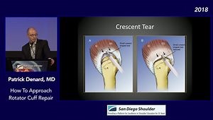 How to Approach Rotator Cuff Repair