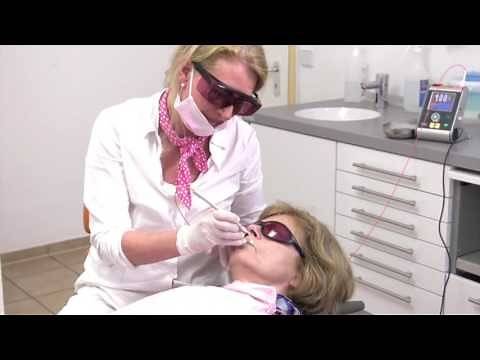 Cold sore and Herpes simplex painless treatment with the Laser (HSV-1 Infection)