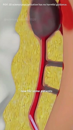 Pilonidal Sinus Laser Treatment | Minimally Invasive Cyst Removal #pilonidalcyst