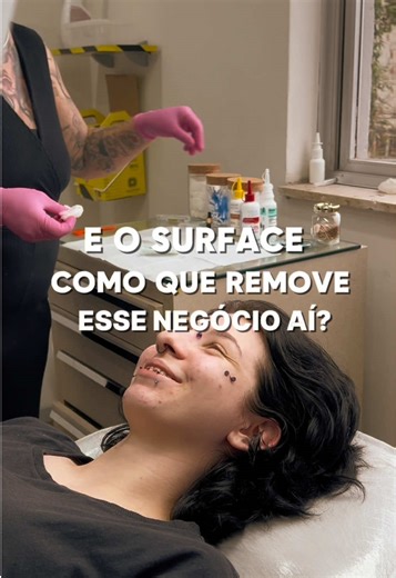 Remoção de Surface Piercing: O Caso do Sebastian
