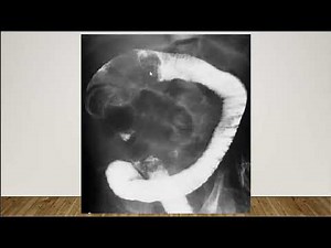 Short Case Discussion : Intussusception