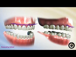 Constricted Chewing Pattern | Dental Braces | Temecula Valley, CA