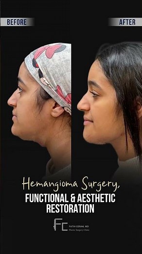 Hemangioma Surgery