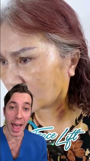 Best Approach to Reduce Swelling After a Facelift