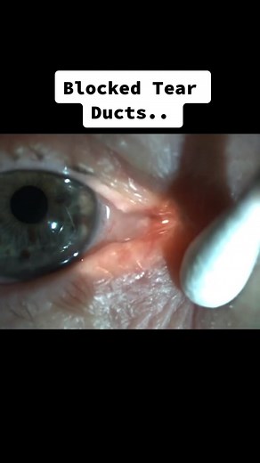 😱😱😱 . . . This level of tear duct blockage can only be treated with surgery…see an oculoplastic surgeon! . . . #ew#eww#wow#dyp#pimple#ouch#eye#eyes#oculoplasticsurgeon#surgeon#surgery#eyedr#theeyedr#eyedoctor