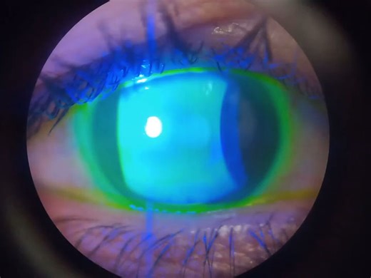 Tear film break up time - 泪膜破裂时间|荧光素钠染色|干眼症