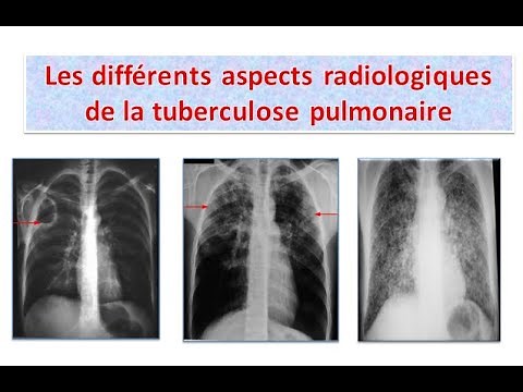 interprétation des clichés thoraciques #tuberculose_pulmonaire (partie 1)