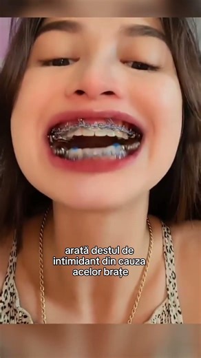 Aparat Dentar HERBST (Dispozitivul Herbst)