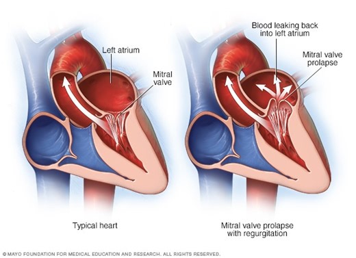Insuficiencia de la válvula mitral - Síntomas y causas - Mayo Clinic