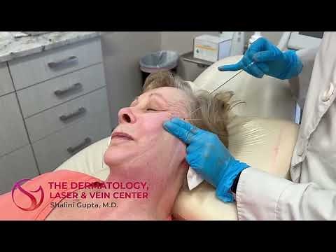 PDO Thread Lift with Before & After Photos | Dr. Shalini Gupta