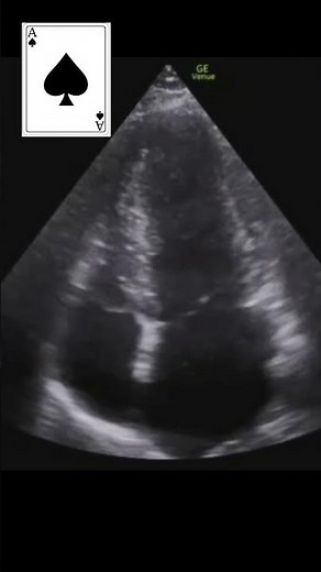 Apical HCM #pocus #emergencymedicine #echofirst