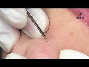 The Service in Our Spa: Blackhead & Hidden Acne Removal.