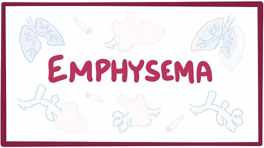 Emphysema: Video, Causes, & Meaning | Osmosis