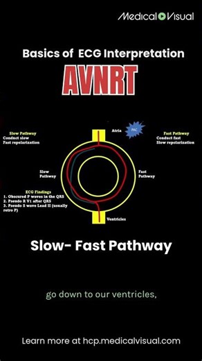 AVNRT is a pathway problem.