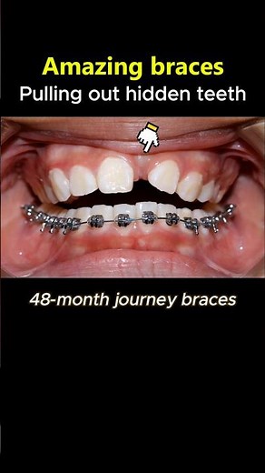 Magic Braces: Pull out hidden teeth process #braces #dentist #orthodontist #orthodontics