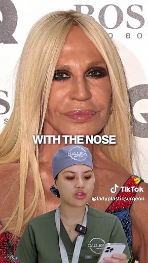 Donatella Versace: Before & After Plastic Surgery ✨ Her glow has been incredible given the pressures she endured in the early 2000s to sustain her look with lots of filler. It’s great to see her return to her beauty
